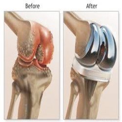 knee2